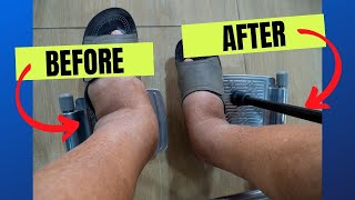 Best Exercises & Remedies To Shrink Ankle Swelling
