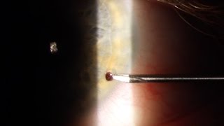 Corneal Foreign Body Removal