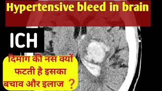 Hypertension bleed In Ct scan / High BP / दिमाग की नस फटने के कारण और रोकथाम /ICH