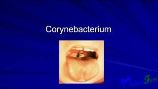 Diphtheria (corynebacterium diphtheriae) and Anthrax (bacillus anthracis) [Gram positive Bacilli]