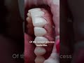 minimal prep veneers by drtejaspatel porcelainveneers atxveneers bestcosmeticdentist