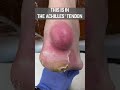 WATCH WHAT COMES OUT OF THIS FOOT! #shorts #gout