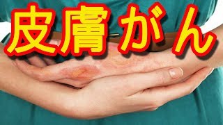 あなたの知らない皮膚がんの真実７選『健康寿命』