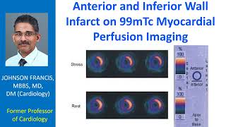 Anterior and inferior wall infarct on 99mTc myocardial perfusion imaging