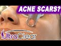 UltraClear Helps with Acne Scars | Non-Surgical Laser Resurfacing