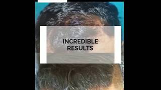 Juvida - The Premier Hair Transplant Clinic