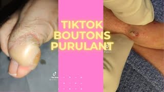 TIKTOK BOUTON PIMPLE POPPING 2