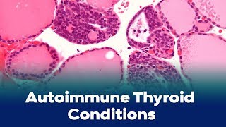 Autoimmune Thyroid Conditions And Why Evaluating TSH Isn't Enough...