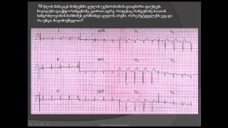 მიოკარდიუმის წინა-გვერდითი კედლის გაურკვეველი ხანგრძლივობის ინფარქტი (ეკგ ატლასი) / ekg atlasi