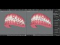 invisalign clincheck cl.iii case problems u0026 how to solve posterior open bite