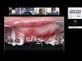 3d bone augmentation technique webinar series canadian implant dentistry network