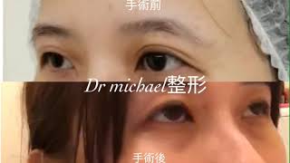 不去皮降窄雙眼皮修復手術—沈筠惇醫師 Dr. Michael 眼整形