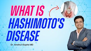 What is Hashimoto's Disease - The Overview