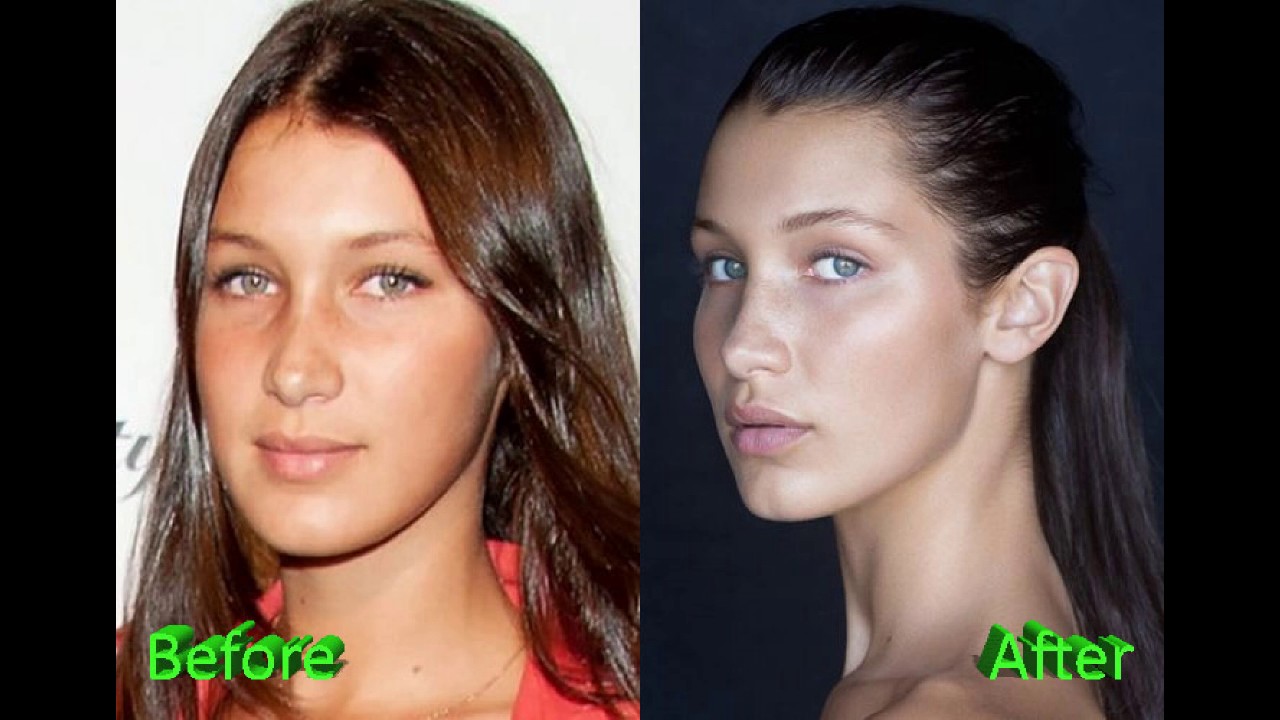 Bella Hadid Before And After Nose Job Plastic Surgery - YouTube