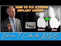 How to Fix a Loose Implant Crown - Dental Minute with Steven T. Cutbirth, DDS