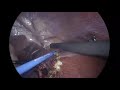 Cherqui-LAPAROSCOPIC SEGMENTECTOMY 7