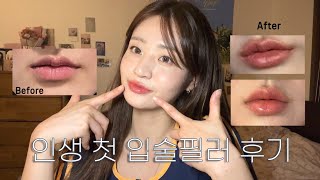 쫄보의 인생 첫 입술 필러 후기💉|아말리안 필러 1cc, 비대칭교정