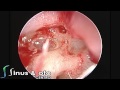 Endoscopic mastoidectomy