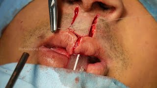 Adult Bilateral Cleft Lip Surgery and Fistula Closer - A complete Surgical Video