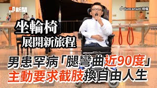 他患罕見疾病「腿彎曲近90度」　主動要求截肢換自由人生｜勵志｜正能量｜纖維性骨失養症