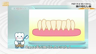 【ズームｅｙｅ】大変ですよ！放っておくと　歯の根むし歯　群馬県歯科医師会(23/02/07)