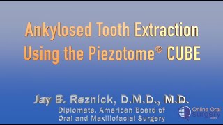 Removal of Ankylosed Tooth #29 with the Piezotome CUBE