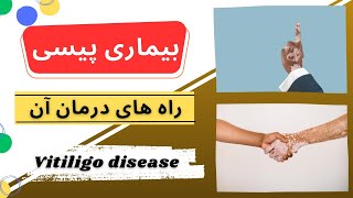 بیماری پیسی و راه های درمان آن (Vitiligo disease)