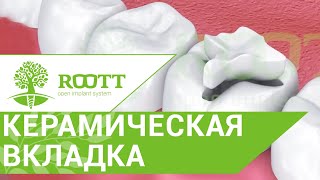 Как устанавливают керамические вкладки, их преимущества. Керамические вкладки установка.