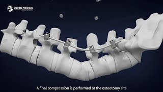 Pedicle Subtraction Osteotomy (PSO) Procedure with Double Medical PSO Instrument Set