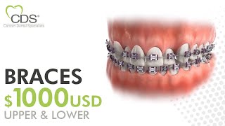 How Braces Are Placed On Teeth? Process at CDS Cancun, Mexico