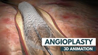 Angioplasty | 3D Animation + Real Footage