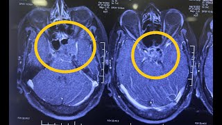 ENDOSCOPIC EXCISION OF CLIVAL LESION- LYMPHOMA