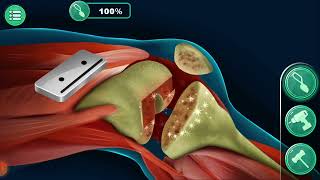 TOTAL KNEE SURGERY REPLACEMENT🦵🦵🦵🦴🦴🦵🦵FULLY 3D ANIMATED