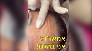 נטע גבות - הסרת קעקוע גבות