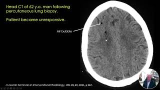 Air Embolism Risk Factors, Detection, and Intervention Presentation