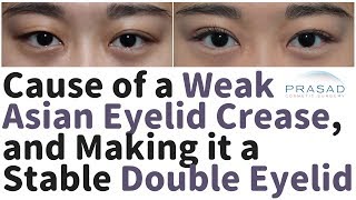 Cause of an Asian Double Eyelid  Becoming a Monolid or Multiple Creases, and How to Stabilize it