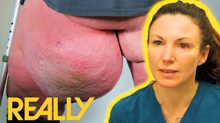 "I'd Like To Get A Knife And Cut It Off!" GIANT Bump Dangles From Patients Leg | The Bad Skin Clinic