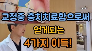 교정중 충치치료함으로써 얻게되는 4가지이득!