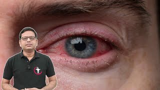 Ciplox Eye/Ear Drops = For Conjunctivitis | Pink Eye Disease | Eye Infection आँखों में इन्फेक्शन