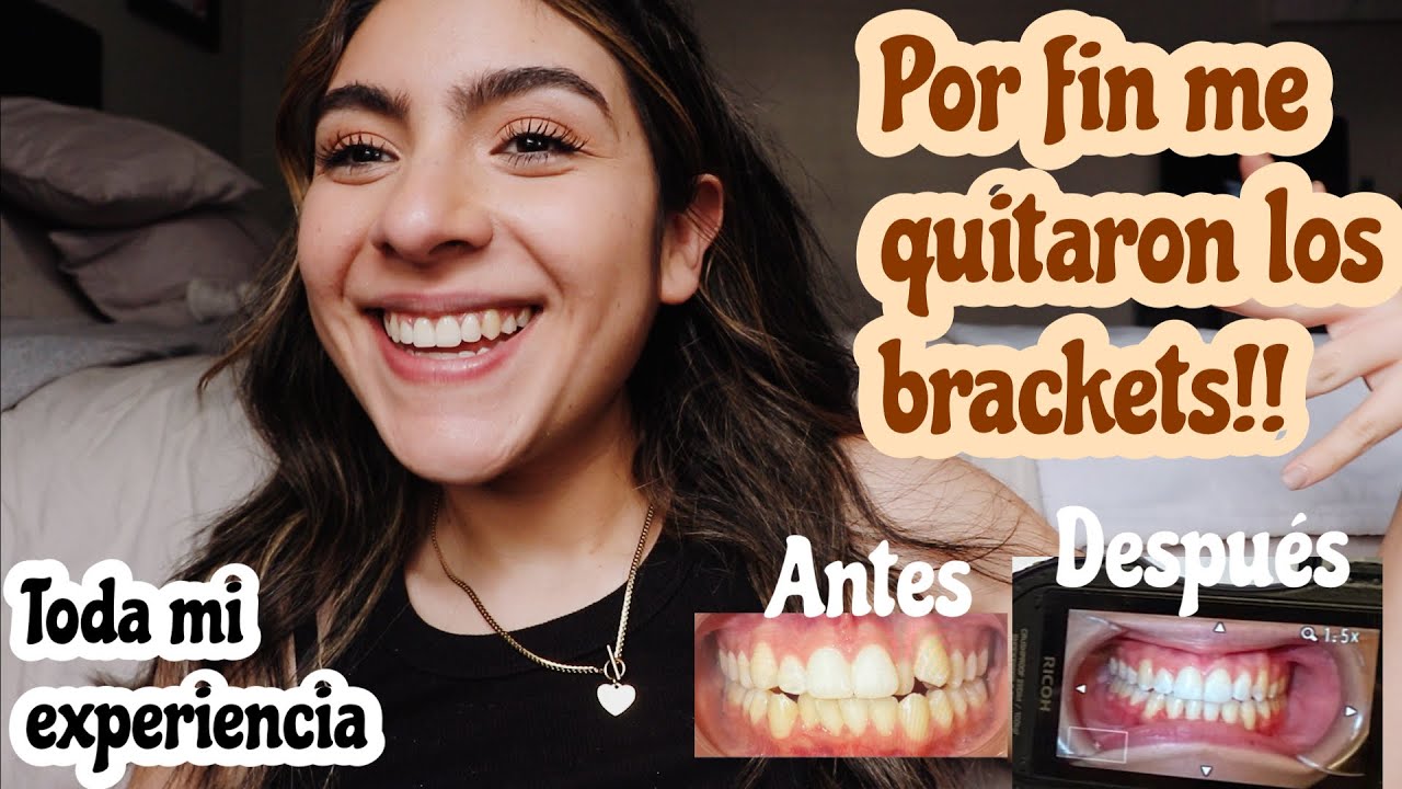 Por Fin Me Quitaron Los Brackets Después De 6 Años!!! Les Cuento Mi ...