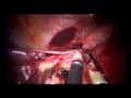 Robotic Single-Site Hysterectomy