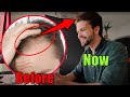 How I Stopped Balding! (no Hair Surgery) | AL GARRIDO