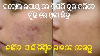 ଘରୋଇ ଉପାୟ ରେ ମୁଁହ ରେ ଥିବା ଛିଦ୍ର ସମସ୍ୟା ରୁ ମୁକ୍ତି ପାଆନ୍ତୁ|Remove Skin Pores Naturally|ଓଡ଼ିଆ