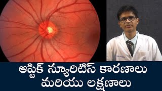 Causes and Symptoms of Optic Neuritis | ఆప్టిక్ న్యూరిటిస్ కారణాలు మరియు లక్షణాలు | Samayam Telugu