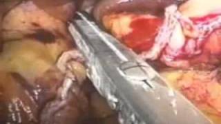 Laparoscopic Wedge Vertical Gastroplasty