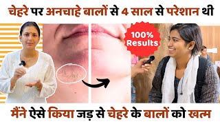 Facial Hair को किया बिना Laser के ठीक | Patient *Review* Hirsutism Ayurvedic Treatment 100% Results