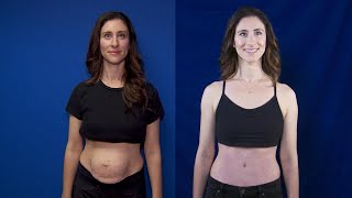 Mom Reclaims Her Pre-Baby Body With Surgery