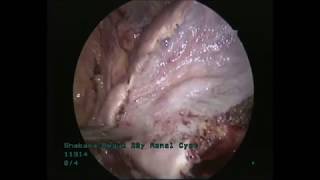 laparoscopic Deroofing of left Renal Cyst 2018