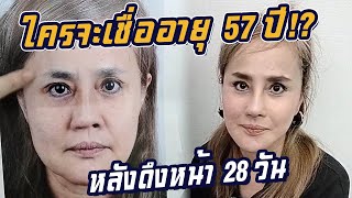 ใครจะเชื่อ อายุ 57ปี  หลังดึงหน้าสองช่วง 28 วัน ธีรพรคลินิก