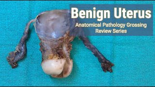 Benign Uterus | Anatomical Pathology Grossing Review Series